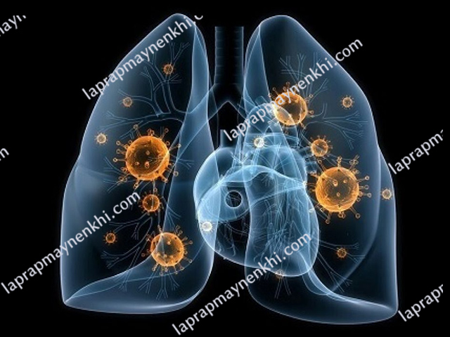 Viêm phổi là bệnh viêm hô hấp dưới thường gặp nhất